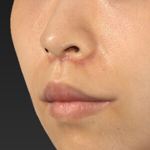 新宿ラクル美容外科クリニック　山本厚志　「人中短縮術（リップリフト）＋口角挙上（スマイルリップ）」　手術後１ヶ月目　１０月１３日