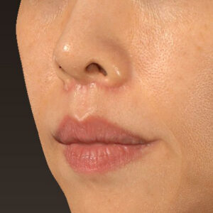 新宿ラクル美容外科クリニック　山本厚志　「人中短縮術（リップリフト）」　手術後１ヶ月目　１０月１４日