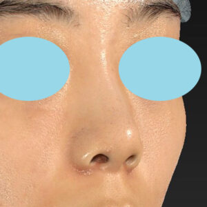 「小鼻縮小+α＋鼻尖縮小（close法）」　新宿ラクル美容外科クリニック　２０代女性　手術後１ヶ月目　１０月１５日