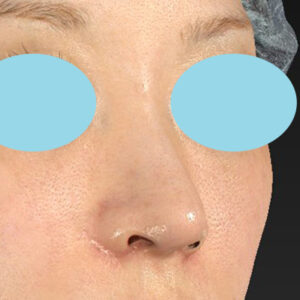 「耳介軟骨移植＋鼻尖縮小（close法）＋小鼻縮小+α＋貴族手術」　新宿ラクル美容外科クリニック　３０代女性　手術後１ヶ月目　１０月２１日