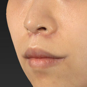 新宿ラクル美容外科クリニック　山本厚志　「人中短縮術（リップリフト）＋口角挙上（スマイルリップ）」　手術後２ヶ月目　１０月１３日