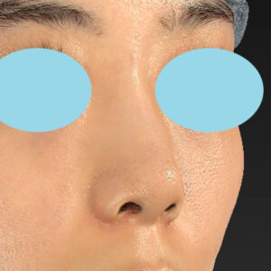 「小鼻縮小+α＋鼻尖縮小（close法）」　新宿ラクル美容外科クリニック　２０代女性　手術後２ヶ月目　１０月１５日