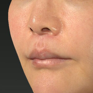 新宿ラクル美容外科クリニック　山本厚志　「人中短縮術（リップリフト）＋口角挙上（スマイルリップ）」　手術後３ヶ月目　１１月２４日