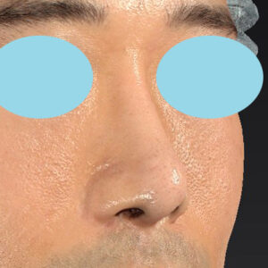 「鼻中隔延長＋耳介軟骨移植＋鼻尖形成＋鼻柱下降＋猫手術＋真皮脂肪移植（鼻尖）＋鼻プロテーゼ隆鼻術」　新宿ラクル美容外科クリニック　２０代女性　手術後３ヶ月目　１１月２６日