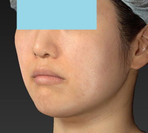 新宿ラクル美容外科クリニック　山本厚志　「ライポライフ脂肪吸引（メーラーファット）＋貴族手術」　手術後３ヶ月目　１０月１０日