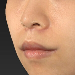 新宿ラクル美容外科クリニック　山本厚志　「人中短縮術（リップリフト）＋口角挙上（スマイルリップ）」　手術後３ヶ月目　１０月１３日