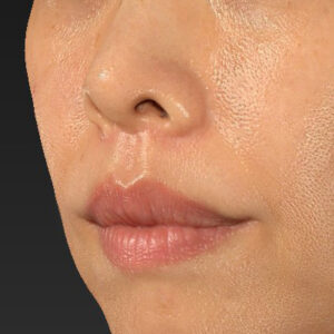 新宿ラクル美容外科クリニック　山本厚志　「人中短縮術（リップリフト）」　手術後３ヶ月目　１１月１１日