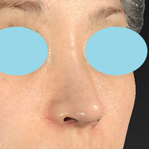 「耳介軟骨移植＋鼻尖縮小（close法）＋小鼻縮小+α＋貴族手術」　新宿ラクル美容外科クリニック　３０代女性　手術後３ヶ月目　１１月１９日