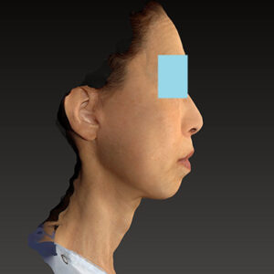 新宿ラクル美容外科クリニック　山本厚志　ナチュラルフェイスネックリフト　手術後３ヶ月目　１１月２２日