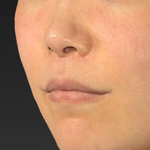 新宿ラクル美容外科クリニック　山本厚志　「人中短縮術（リップリフト）＋口角挙上（スマイルリップ）」　手術後６ヶ月目　１０月１１日