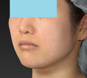 新宿ラクル美容外科クリニック　山本厚志　「ライポライフ脂肪吸引（メーラーファット）＋貴族手術」　手術後６ヶ月目　１２月１９日