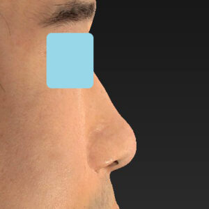 「鼻中隔延長＋耳介軟骨移植＋鼻尖形成＋鼻柱下降＋猫手術＋真皮脂肪移植（鼻尖）＋鼻プロテーゼ隆鼻術」　新宿ラクル美容外科クリニック　２０代女性　手術前　１０月２２日