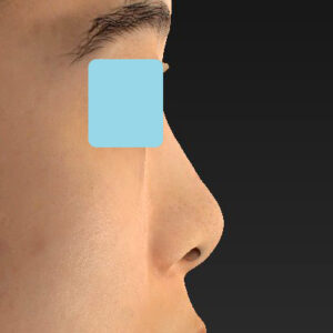 「小鼻縮小+α＋鼻尖縮小（close法）」　新宿ラクル美容外科クリニック　２０代女性　手術前　１０月１５日