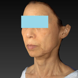 新宿ラクル美容外科クリニック　山本厚志　ナチュラルフェイスネックリフト　手術前　１０月２５日