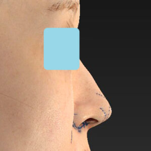 「耳介軟骨移植＋鼻尖縮小（close法）＋小鼻縮小+α＋貴族手術」　新宿ラクル美容外科クリニック　３０代女性　デザイン　１０月２１日