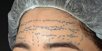 デザイン 新宿ラクル美容外科クリニック 山本厚志 「額の若返り(ジュビダームビスタ・ボリューマXC)」 デザイン 10月23日