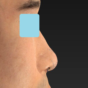 「鼻中隔延長＋耳介軟骨移植＋鼻尖形成＋鼻柱下降＋猫手術＋真皮脂肪移植（鼻尖）＋鼻プロテーゼ隆鼻術」　新宿ラクル美容外科クリニック　２０代女性　デザイン　１０月２２日