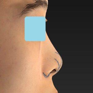 「小鼻縮小+α＋鼻尖縮小（close法）」　新宿ラクル美容外科クリニック　２０代女性　デザイン　１０月１５日