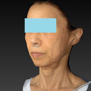 新宿ラクル美容外科クリニック　山本厚志　ナチュラルフェイスネックリフト　デザイン　１０月２５日