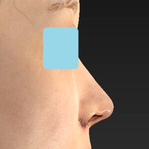 「耳介軟骨移植＋鼻尖縮小（close法）＋小鼻縮小+α＋貴族手術」　新宿ラクル美容外科クリニック　３０代女性　手術直後　１０月２１日