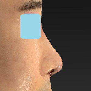 「鼻中隔延長＋耳介軟骨移植＋鼻尖形成＋鼻柱下降＋猫手術＋真皮脂肪移植（鼻尖）＋鼻プロテーゼ隆鼻術」　新宿ラクル美容外科クリニック　２０代女性　手術直後　１０月２２日