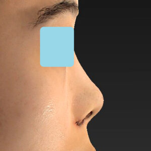 「小鼻縮小+α＋鼻尖縮小（close法）」　新宿ラクル美容外科クリニック　２０代女性　手術直後　１０月１５日