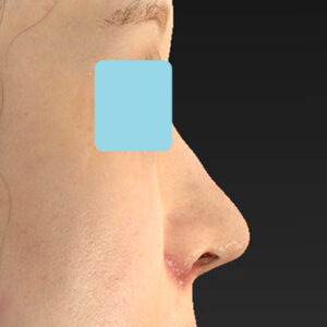 「耳介軟骨移植＋鼻尖縮小（close法）＋小鼻縮小+α＋貴族手術」　新宿ラクル美容外科クリニック　３０代女性　手術後１週間目　１０月２１日