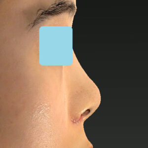 「小鼻縮小+α＋鼻尖縮小（close法）」　新宿ラクル美容外科クリニック　２０代女性　手術後１週間目　１０月１５日