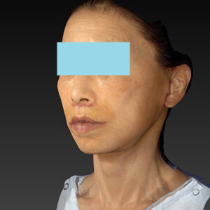 新宿ラクル美容外科クリニック　山本厚志　ナチュラルフェイスネックリフト　手術後１週間目　１０月２５日