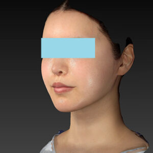 新宿ラクル美容外科クリニック　山本厚志　ナチュラルフェイスリフト　手術後１２ヶ月目　４月３０日