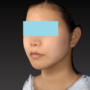 新宿ラクル美容外科クリニック　山本厚志　ナチュラルフェイスリフト　手術後１２ヶ月目　３月２９日