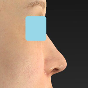 「耳介軟骨移植＋鼻尖縮小（close法）＋小鼻縮小+α＋貴族手術」　新宿ラクル美容外科クリニック　３０代女性　手術後１ヶ月目　１０月２１日