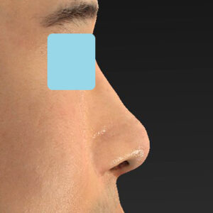 「鼻中隔延長＋耳介軟骨移植＋鼻尖形成＋鼻柱下降＋猫手術＋真皮脂肪移植（鼻尖）＋鼻プロテーゼ隆鼻術」　新宿ラクル美容外科クリニック　２０代女性　手術後１ヶ月目　１０月２２日