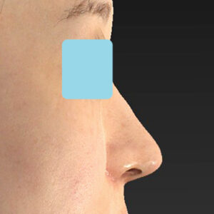 「耳介軟骨移植＋鼻尖縮小（close法）＋小鼻縮小+α＋貴族手術」　新宿ラクル美容外科クリニック　３０代女性　手術後２ヶ月目　１０月２１日