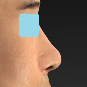 「鼻中隔延長＋耳介軟骨移植＋鼻尖形成＋鼻柱下降＋猫手術＋真皮脂肪移植（鼻尖）＋鼻プロテーゼ隆鼻術」　新宿ラクル美容外科クリニック　２０代女性　手術後２ヶ月目　１０月２２日