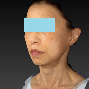 新宿ラクル美容外科クリニック　山本厚志　ナチュラルフェイスネックリフト　手術後２ヶ月目　１０月２５日