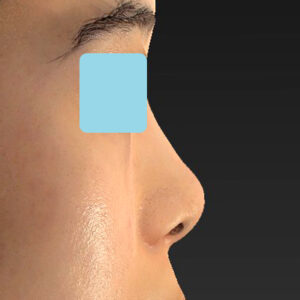 「小鼻縮小+α＋鼻尖縮小（close法）」　新宿ラクル美容外科クリニック　２０代女性　手術後２ヶ月目　１０月１５日