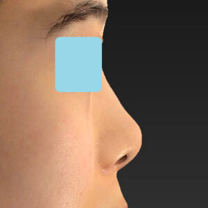 「小鼻縮小+α＋鼻尖縮小（close法）」　新宿ラクル美容外科クリニック　２０代女性　手術後３ヶ月目　１１月１６日