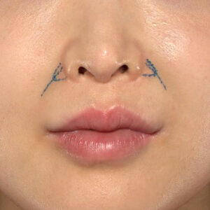 新宿ラクル美容外科クリニック　山本厚志　「貴族手術（鼻翼基部プロテーゼ）」　デザイン　１１月２０日