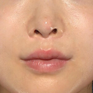新宿ラクル美容外科クリニック　山本厚志　「貴族手術（鼻翼基部プロテーゼ）」　手術直後　１１月２０日