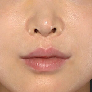 新宿ラクル美容外科クリニック　山本厚志　「貴族手術（鼻翼基部プロテーゼ）」　手術後１週間目　１１月２０日