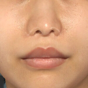 手術後12ヶ月目 新宿ラクル美容外科クリニック 山本厚志 「人中短縮術(リップリフト)」 手術後12ヶ月目 4月6日