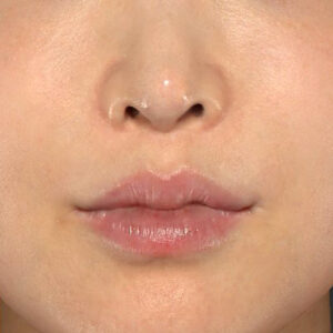新宿ラクル美容外科クリニック　山本厚志　「貴族手術（鼻翼基部プロテーゼ）」　手術後１２ヶ月目　５月１０日