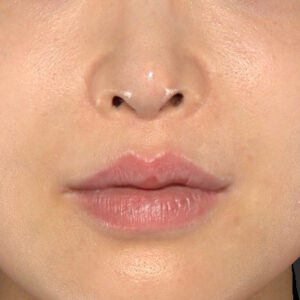 新宿ラクル美容外科クリニック　山本厚志　「貴族手術（鼻翼基部プロテーゼ）」　手術後１ヶ月目　１１月２０日