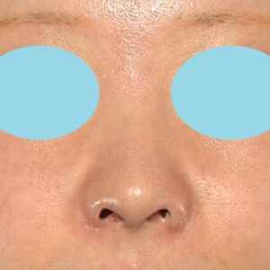 新宿ラクル美容外科クリニック　山本厚志　「小鼻縮小+α法」　手術後２ヶ月目　１２月３日