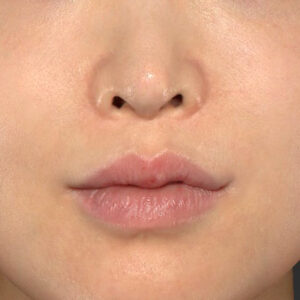 新宿ラクル美容外科クリニック　山本厚志　「貴族手術（鼻翼基部プロテーゼ）」　手術後６ヶ月目　１１月２０日