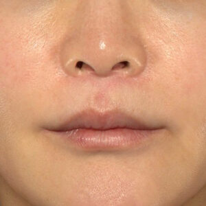 新宿ラクル美容外科クリニック　山本厚志　「人中短縮術（リップリフト）＋口角挙上（スマイルリップ）」　手術後６ヶ月目　１月１０日