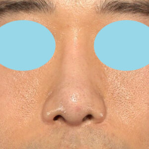 「鼻中隔延長＋耳介軟骨移植＋鼻尖形成＋鼻柱下降＋猫手術＋真皮脂肪移植（鼻尖）＋鼻プロテーゼ隆鼻術」　新宿ラクル美容外科クリニック　２０代女性　手術後６ヶ月目　２月１２日