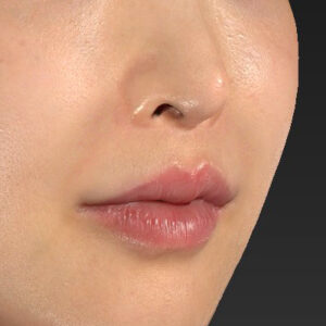 新宿ラクル美容外科クリニック　山本厚志　「貴族手術（鼻翼基部プロテーゼ）」　手術前　１１月２０日