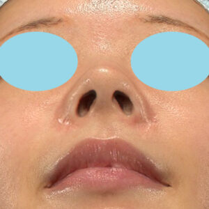 新宿ラクル美容外科クリニック　山本厚志　「小鼻縮小+α法」　手術前　１１月３日